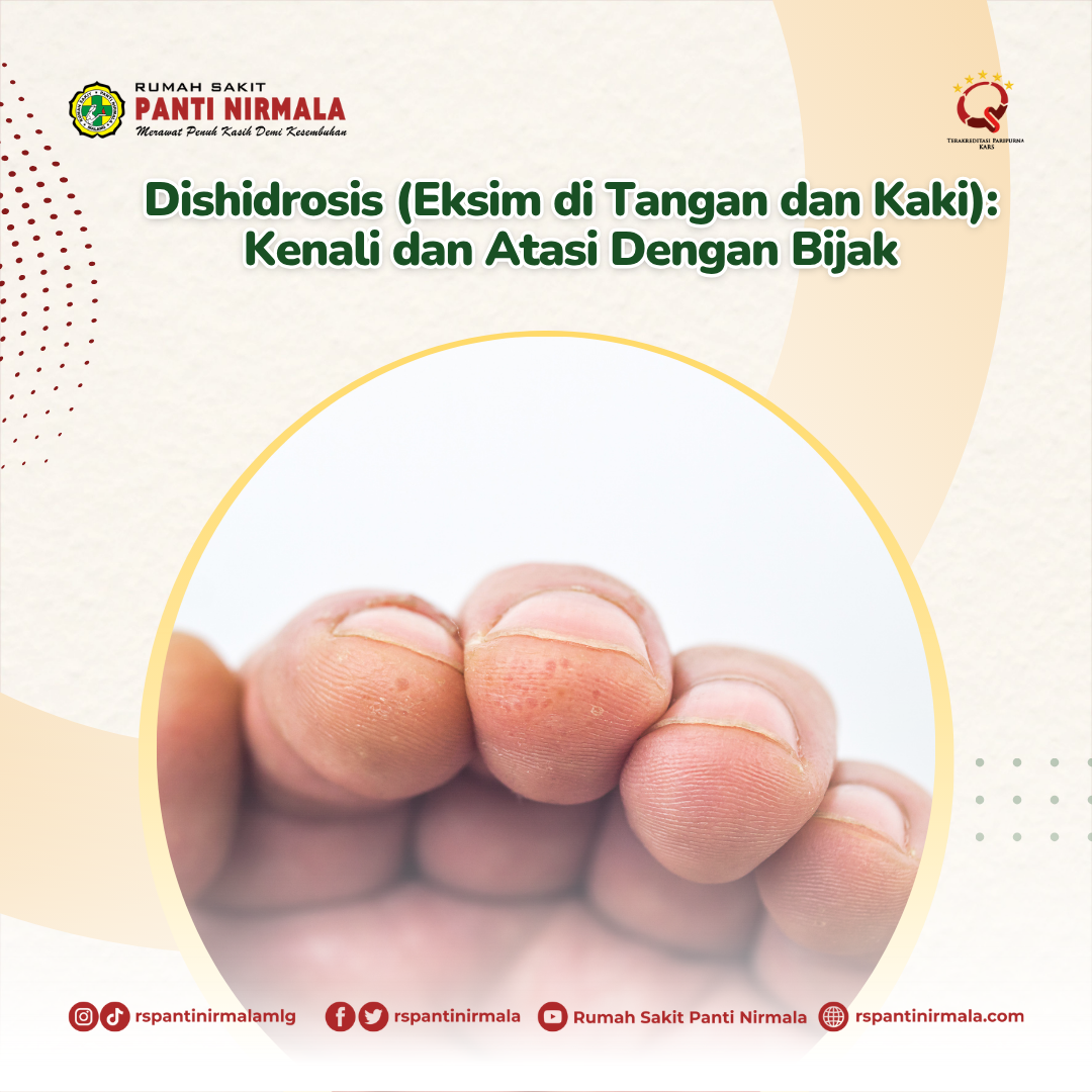 Dishidrosis (Eksim di Tangan dan Kaki): Kenali dan Atasi Dengan Bijak